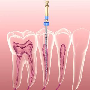 دوره آموزش عصب کشی دندان